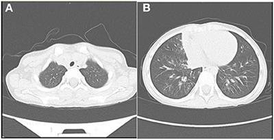 Multisystem inflammatory syndrome (MIS-C) with SARS-CoV-2 omicron variant BA.2.38 in a four-year-old Chinese girl: A case report